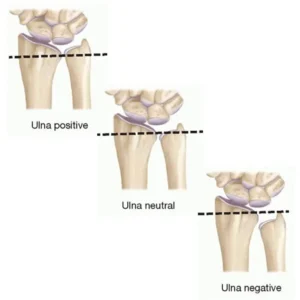 Ulnar variance - consult Prep Performance Center