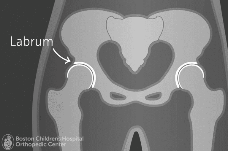 Hip Labral Tear Hip Injections in Adolescent Chicago Athlete