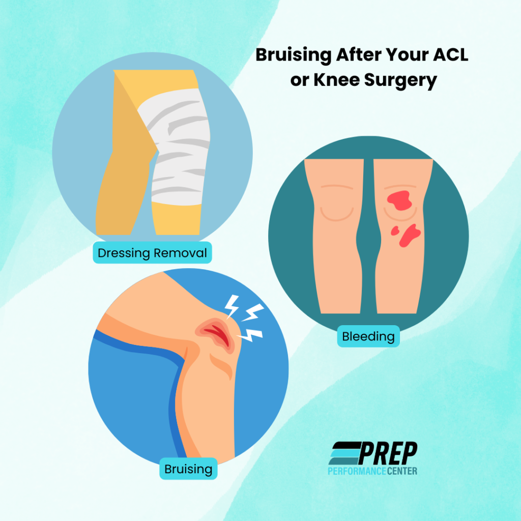 Bruising After Your ACL or Knee Surgery